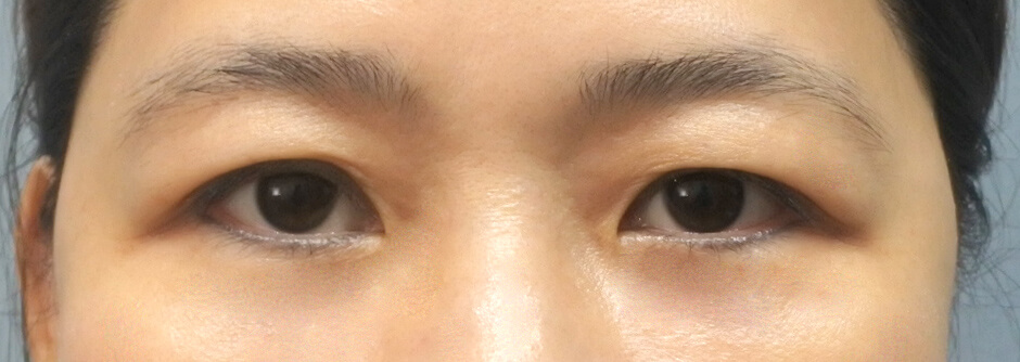 楊氏羅丹,黑眼圈,眼袋淚溝,眼袋,台北醫美